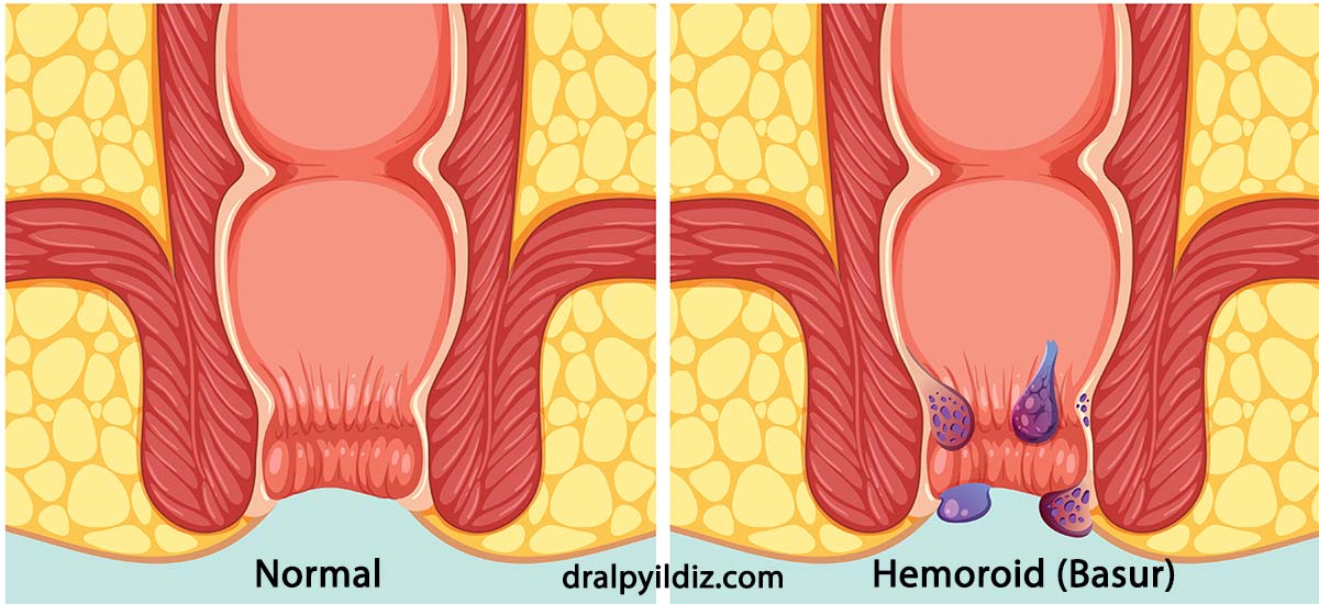 Hemoroid (Basur) Nedir? Hemoroid (Basur) Belirtileri ve Tedavisi Nasıl Yapılır? Hemoroid tedavi yöntemleri nelerdir?
