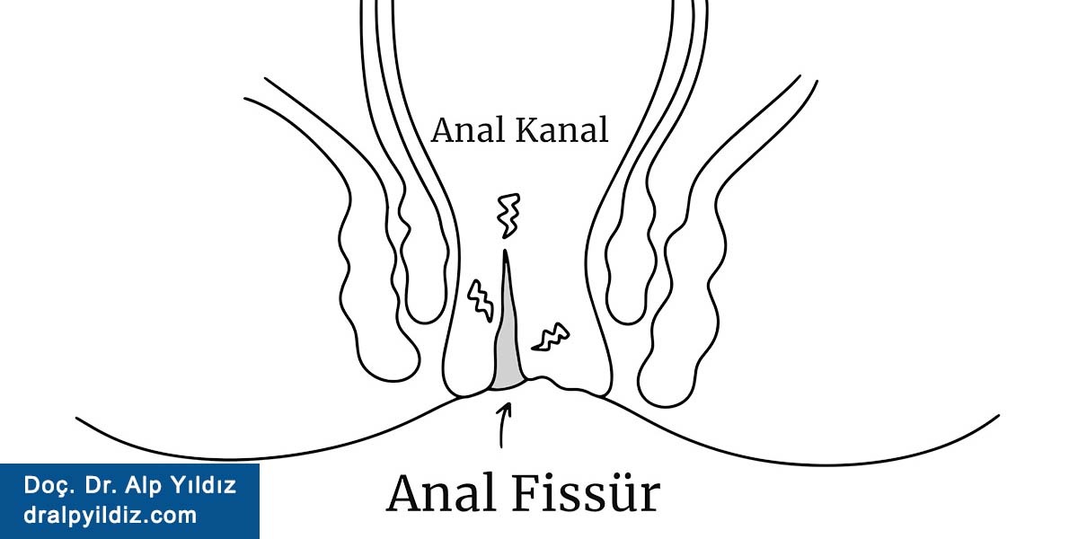 Anal Fissür (Makat Çatlağı) Nedir? Anal Fissür (Makat Çatlağı) Belirtileri Nelerdir? Anal Fissür (Makat Çatlağı) Tedavisi Nasıl Yapılır?