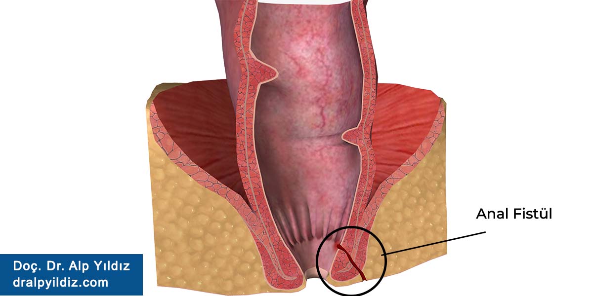 Anal Fistül Nedir? Anal Fistül Belirtileri, Nedenleri ve Tedavi Yöntemleri