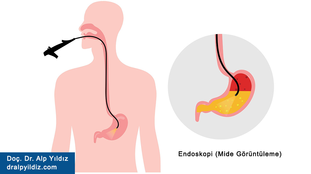 Endoskopi (Mide Görüntüleme) Nedir, Nasıl Yapılır?