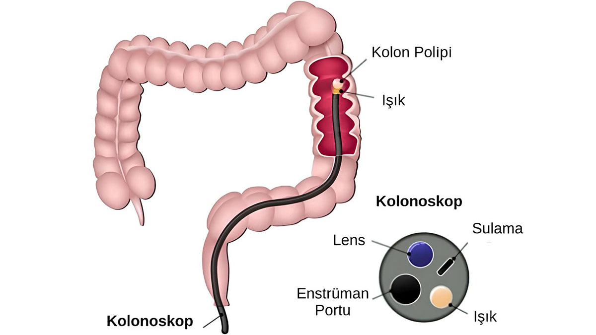 Kolonoskopi Nedir? Kolonoskopi Nasıl Yapılır?