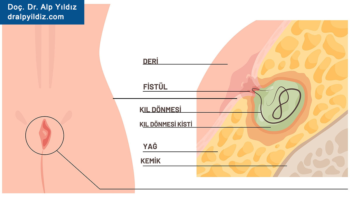 Kıl Dönmesi Nedir? Kıl Dönmesi Belirtileri ve Tedavi Yöntemleri